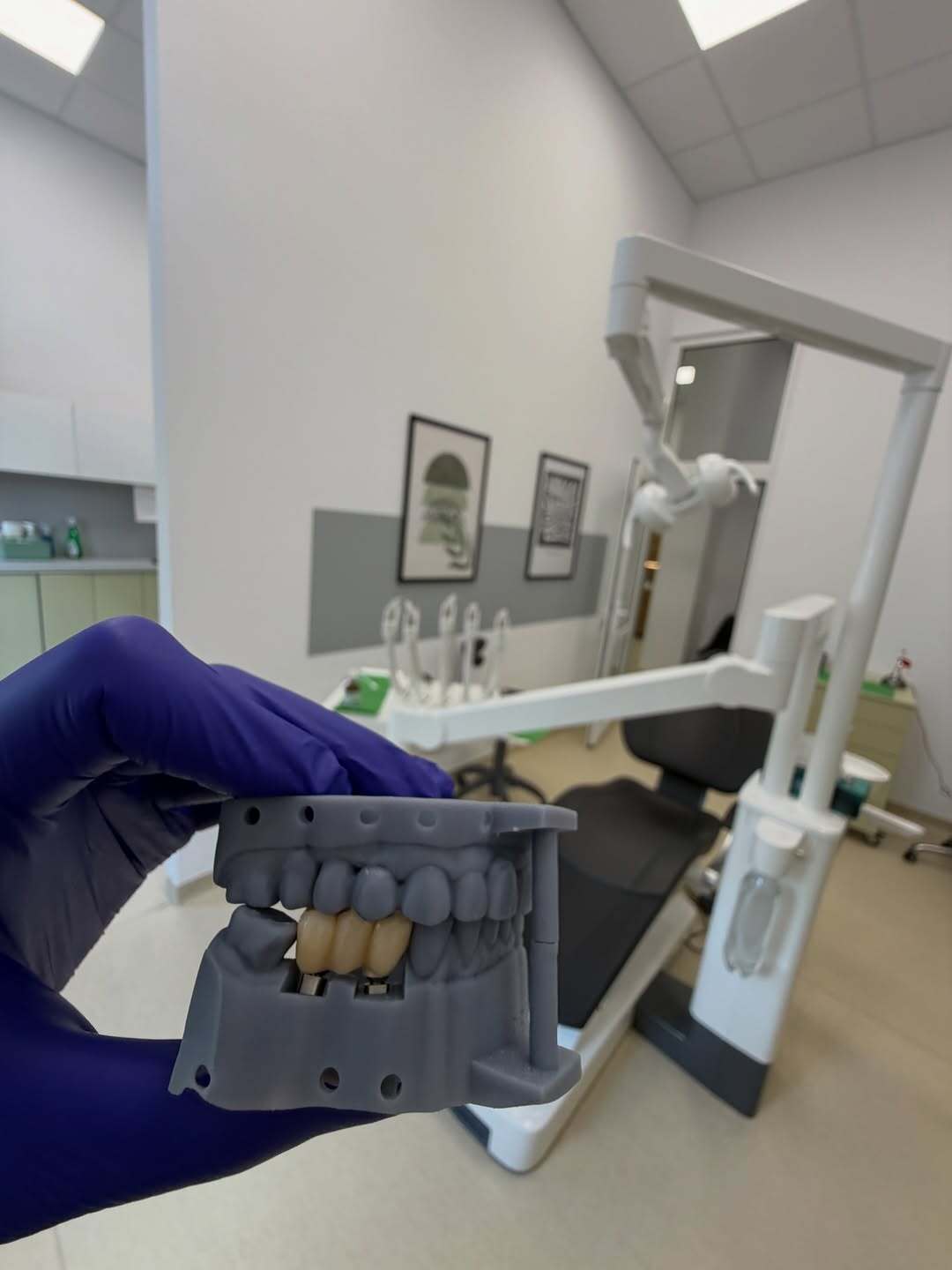 Mână cu mănușă ținând modelul unei lucrări dentare pe implanturi, în fața unitului dentar